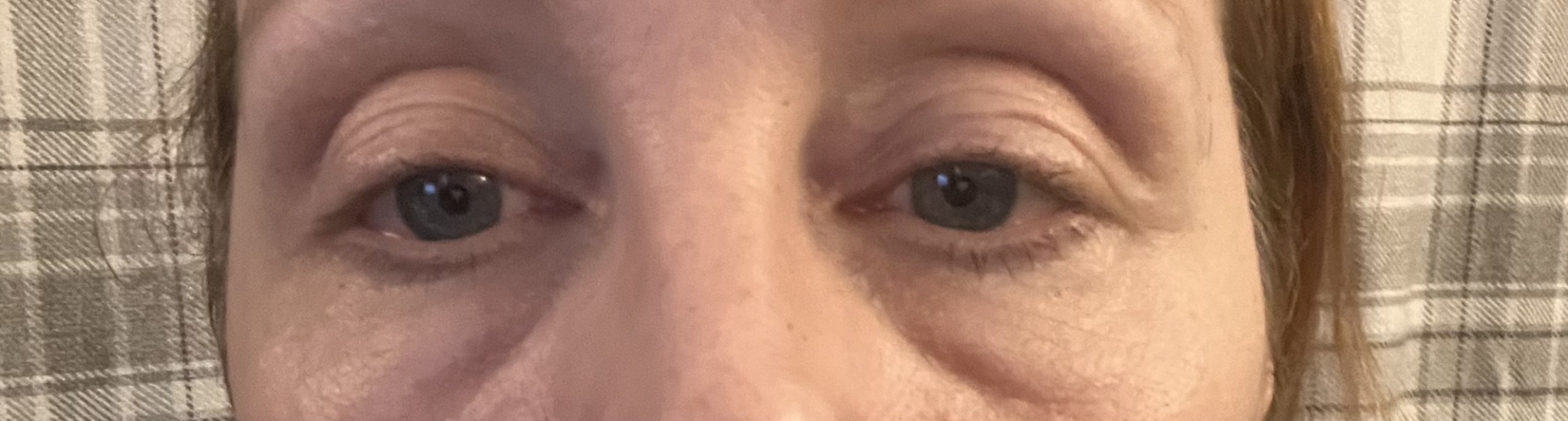 Under eye issues