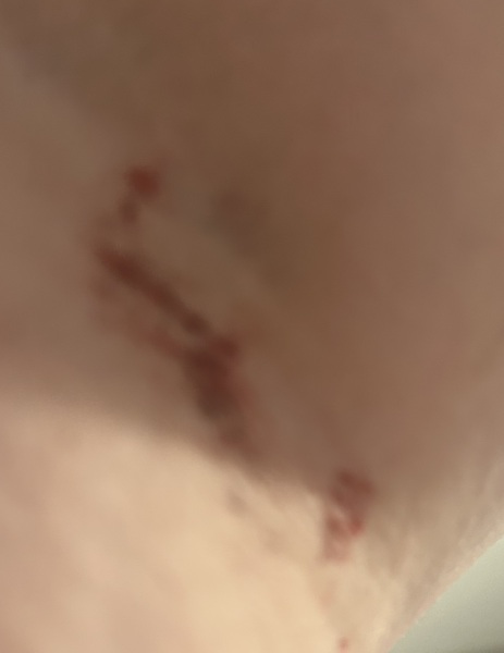 To ask if this is normal for a blood test to leave this mark
