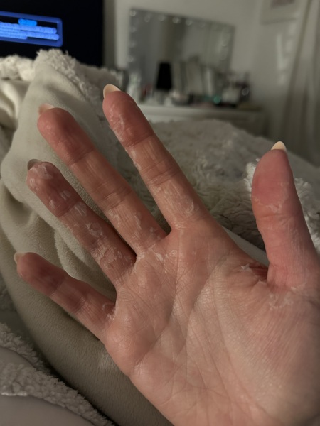 Very flaky hands