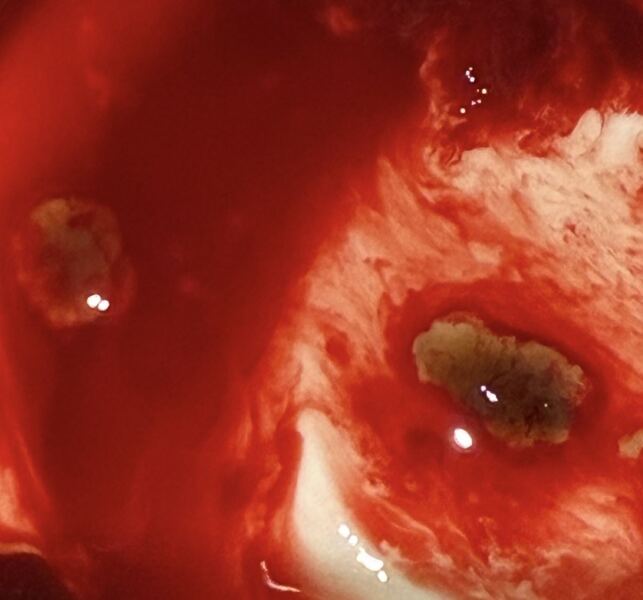 TW Miscarriage photo - is this the sac or just blood clot?