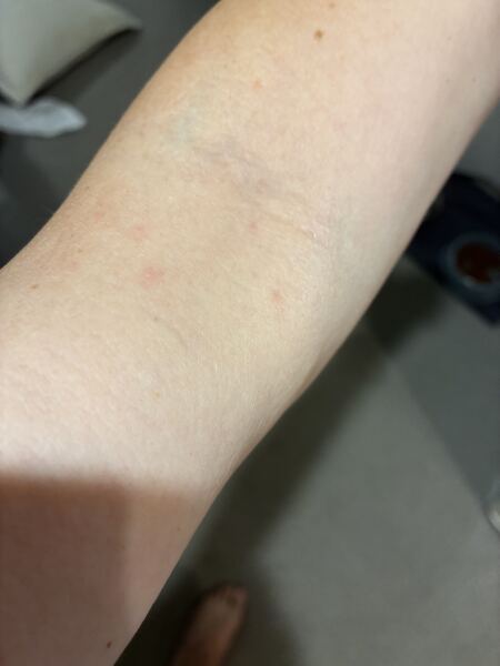 For those who have had scabies…