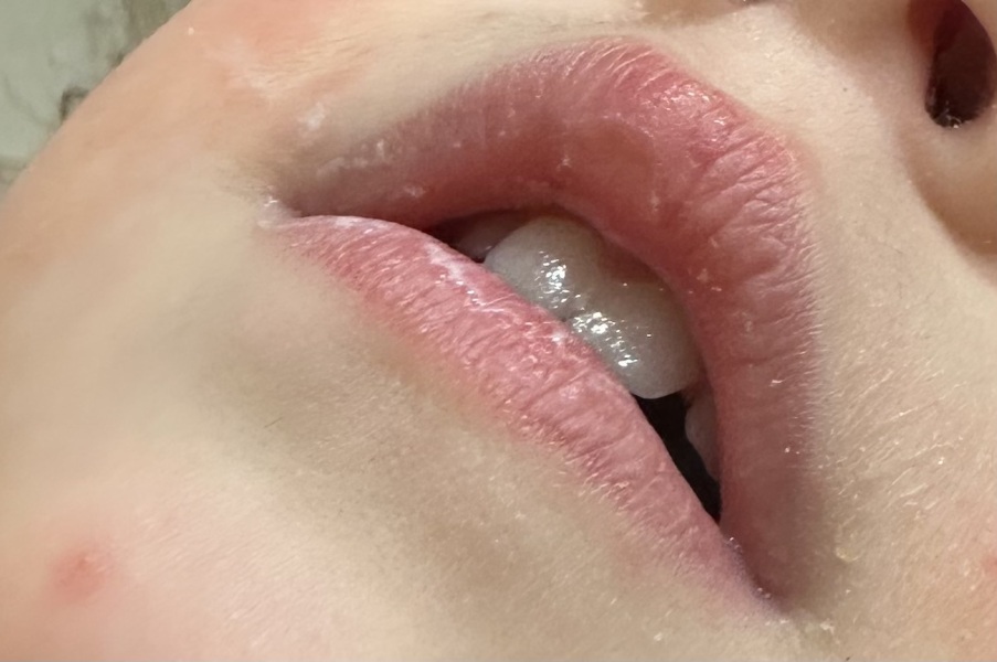 Toddler cold sore?