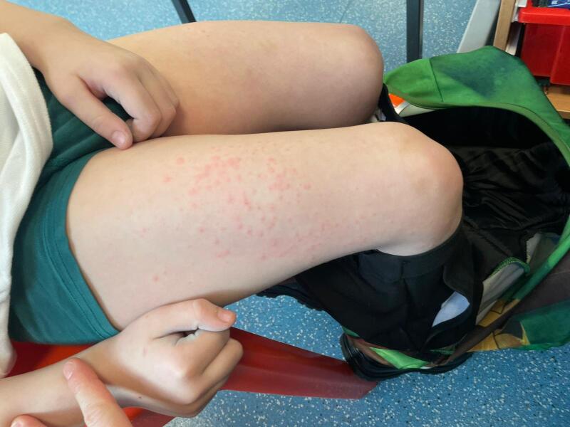 Sudden rash on DS' legs. What does it look like to you?