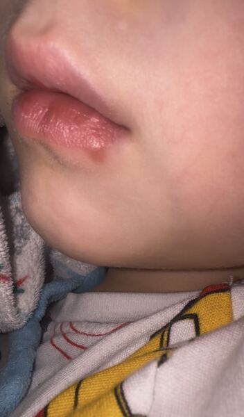 Is this a cold sore? 3yo