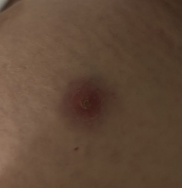 To be worried about this on my breast?
