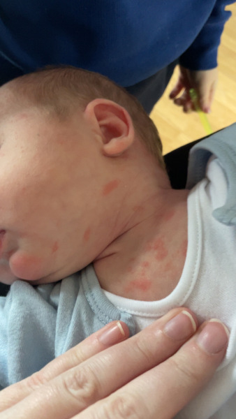 Any idea about this rash?