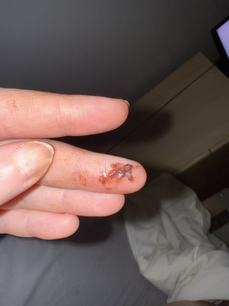 Concerning bleeding warning picture attached