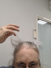 Hair regrowth.
