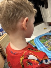 Lump behind ear- chicken pox?
