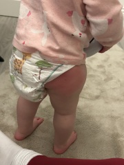 Swollen legs after vaccination