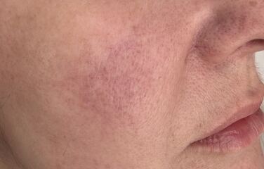 Current body mask or salon IPL?