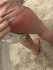 Swollen legs after vaccination