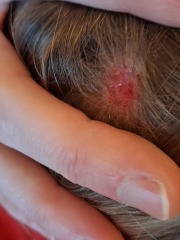 Scalp scab