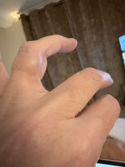 What is this lump on my finger? A ganglion?