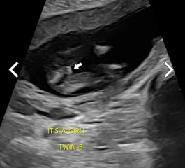 Anyone think early scan at 15 weeks for twins could be wrong??