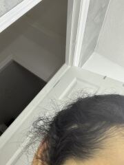 Hair loss. Please help!! Panic!