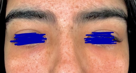 Please help me fade these freckles (pics)