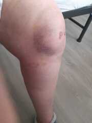 Feel lucky to be alive after falling forward down my stairs.
