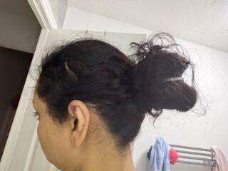 Hair loss. Please help!! Panic!