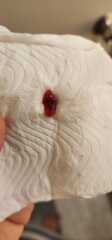 Is this a very early miscarriage?