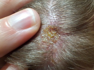 Scalp scab