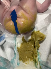 Babies bowl movements