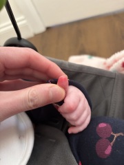 4 month old red and swollen thumb