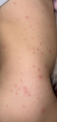Mysterious red spots on toddler