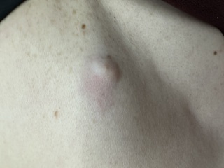 Infected cyst!