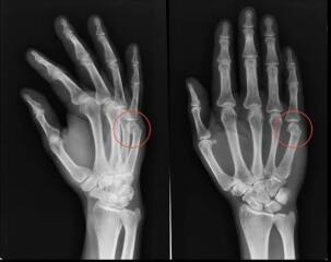 Hand issues