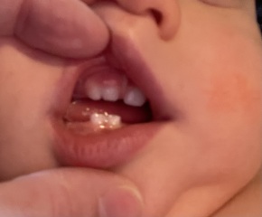 Does anyone have a child with teeth fused together?