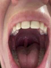 Agonising throat - pics