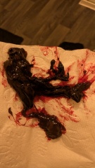 Would you wait? TW blood clots