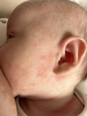 Rash that just won’t disappear, help?!