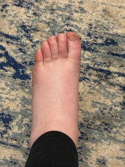 DVT? Third Trimester