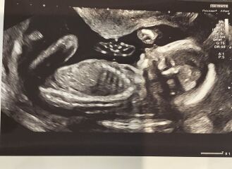 Any guesses on the gender of my little one 🩷🩵 I can’t seem to see a numb but not sure if its just me 🤔.