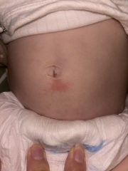 Spots/rash baby