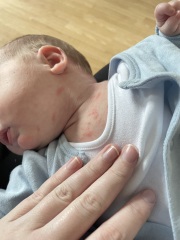 Any idea about this rash?