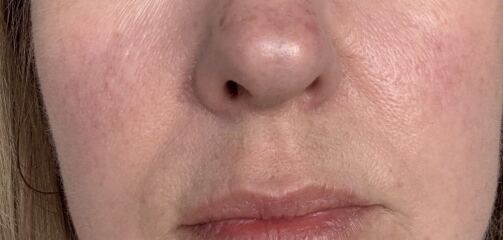 Current body mask or salon IPL?