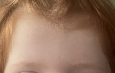 Chicken pox pock marks- the after scars! 