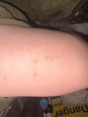 Random bruising and leg paid