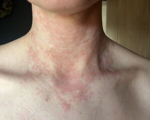 Contact dermatitis