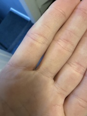 Right hand is constantly dry, cracked and painful while my left is fine