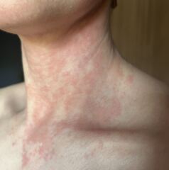 Contact dermatitis