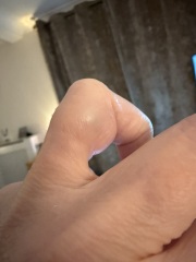 What is this lump on my finger? A ganglion?