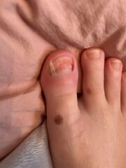 Why does my toenail keep falling off? (Photos)
