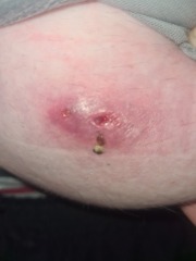 Skin Abscess Photos Attached.
