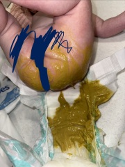 Babies bowl movements