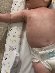 Rash that just won’t disappear, help?!