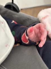 4 month old red and swollen thumb